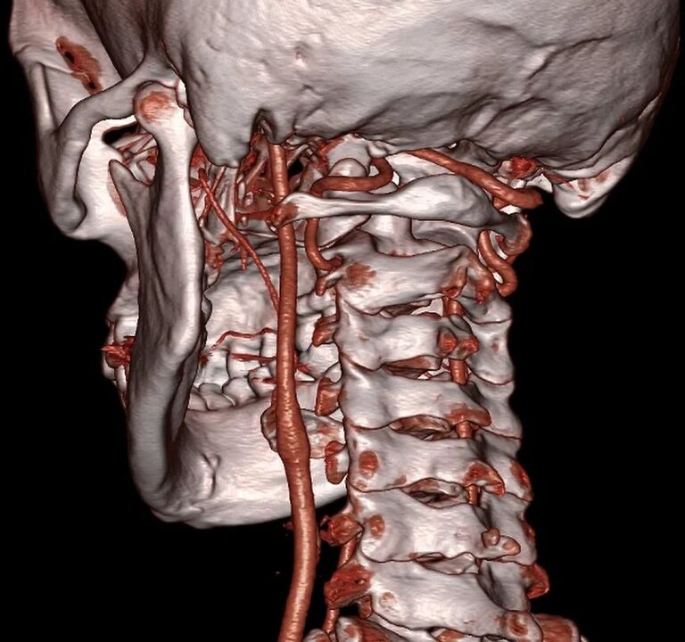Compressed artery with cervical osteonecrosis