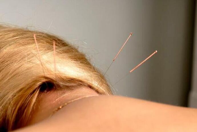 acupuncture for osteonecrosis