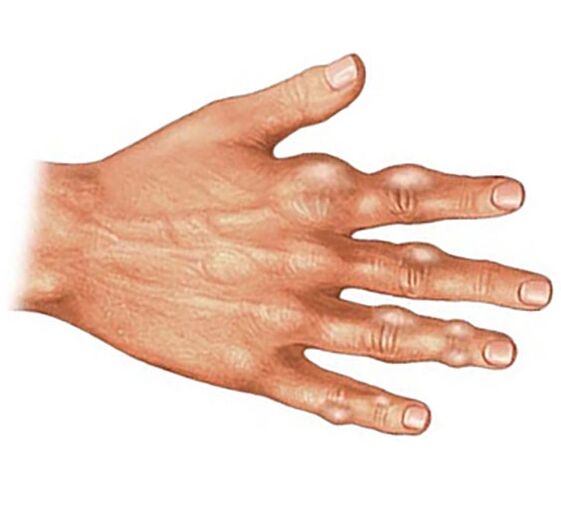 Deposit of uric acid crystals in the soft tissues of gouty arthritis fingers