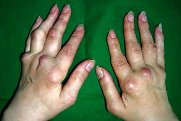 Hand affected by polyarticular deformity