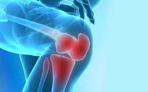 What is arthritis of the knee joint 