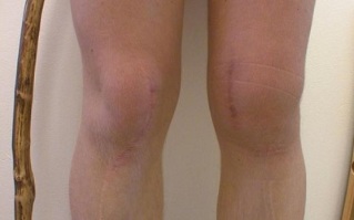 developmental stages of knee arthritis