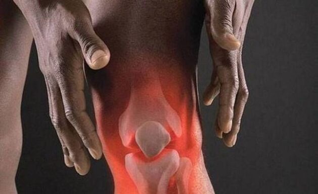 Osteoarthritis accompanied by inflammatory process in the knee joint